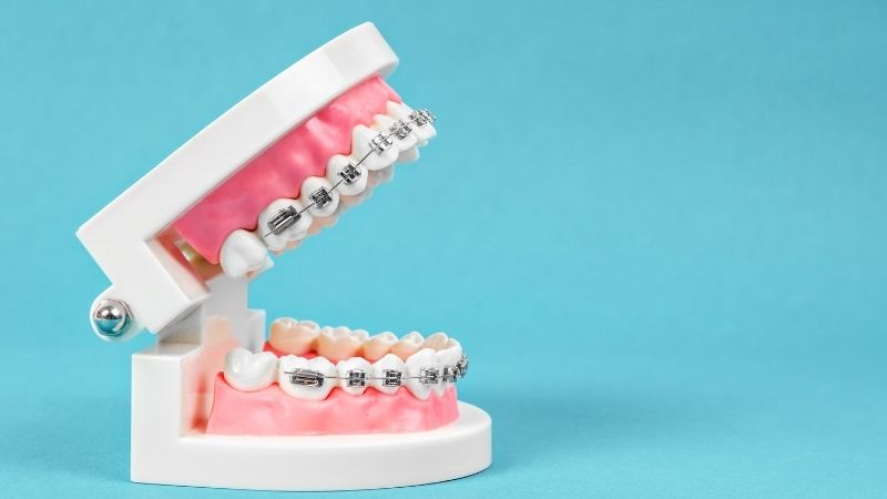 Adult orthodontics in kent island