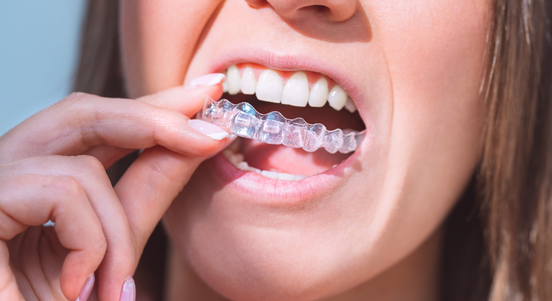 Get affordable invisalign