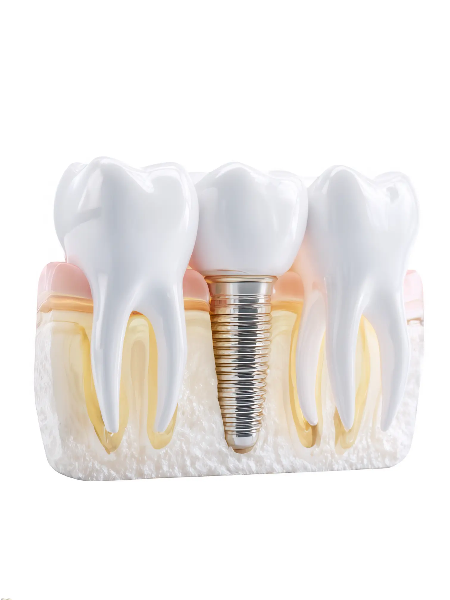 Affordable dental implants