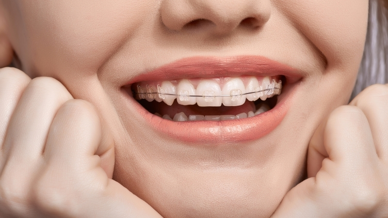 Orthodontist for Kids in Annapolis, MD