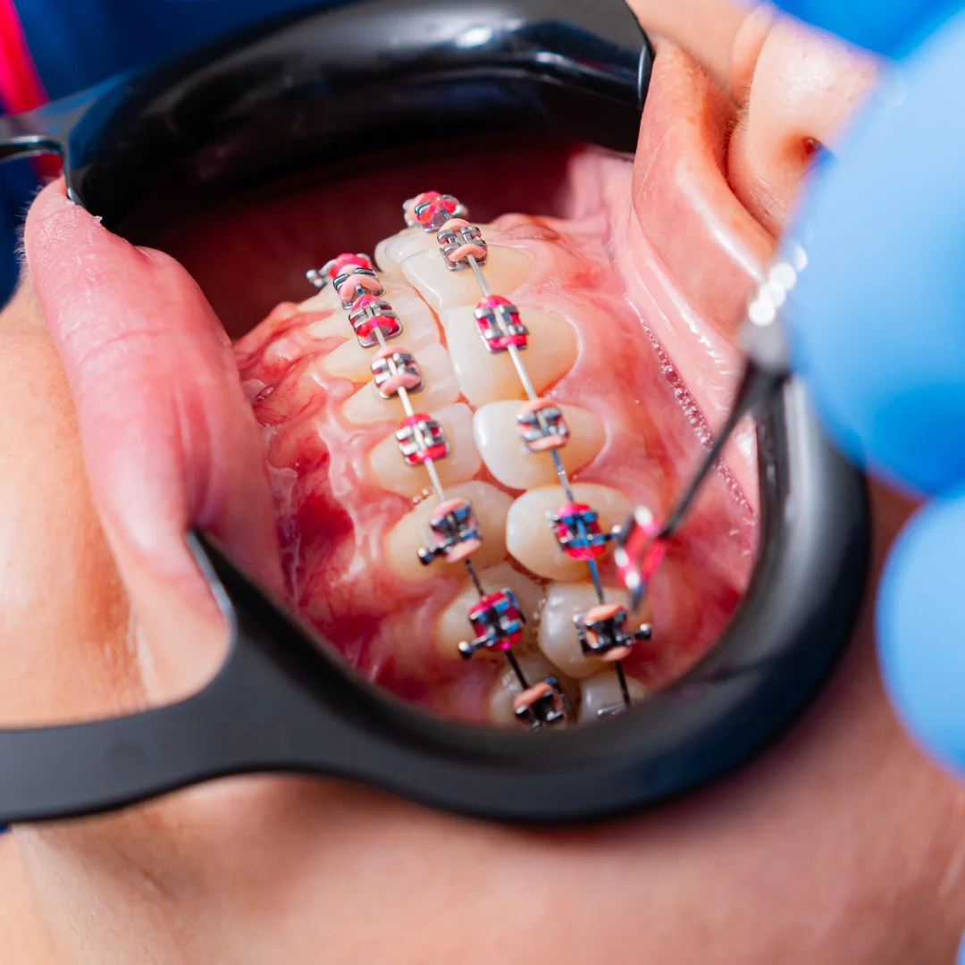 Color braces for teeth