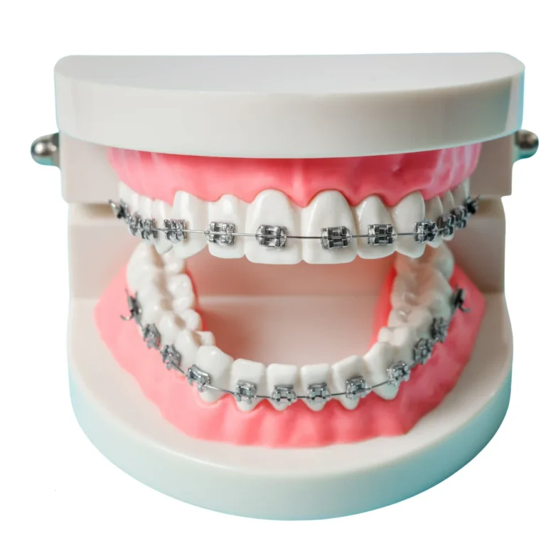 Dental Braces