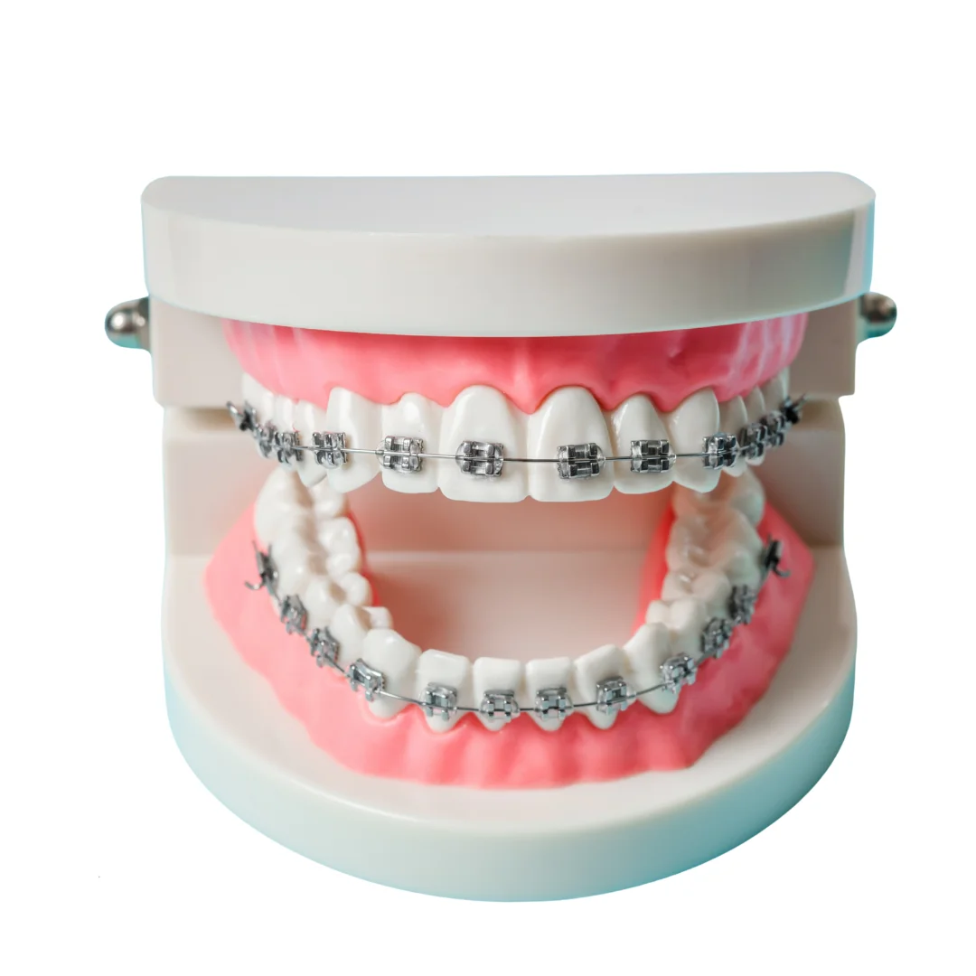 Dental braces cost (3)