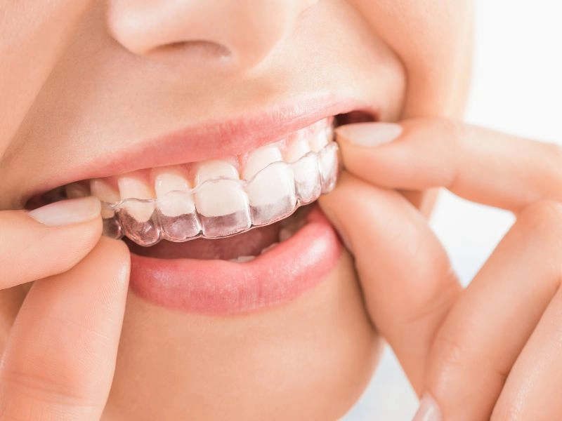 Invisalign in Annapolis MD &mdash; Benkovich Orthodontics