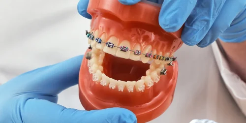 Types of Braces